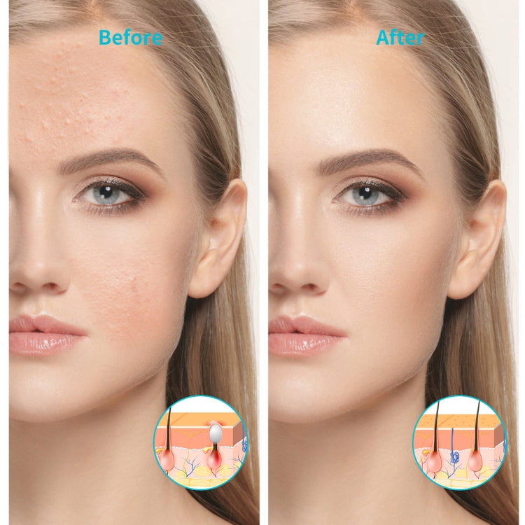XPREEN XPRE052 อุปกรณ์รักษาสิวแบบชาร์จไฟได้แบบไร้สาย Home Acne Clearing Eraser พร้อมแสงสีฟ้าและแสงสีแดง, XPRE052