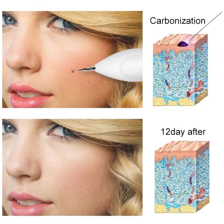 Dark Spot Remover USB เลเซอร์พลาสม่าปากกา Facial Freckle Wart Removal Beauty Care อุปกรณ์