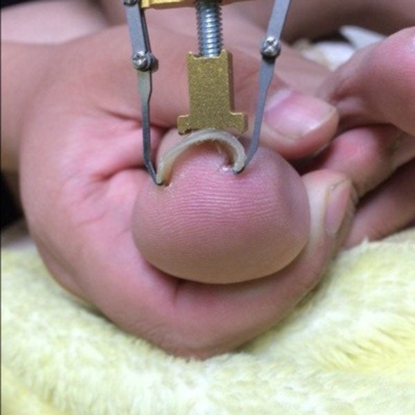 เล็บเท้าคุดเล็บเท้าเล็บเท้าดูแลเครื่องมือ Bunion Corrector สำหรับนิ้วเท้า