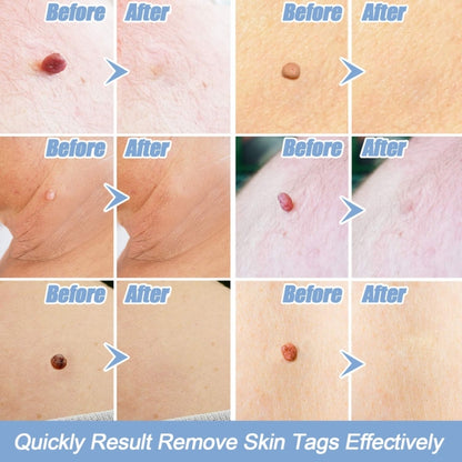 เครื่องมือกำจัดแท็กผิวหนังสำหรับแท็กผิวหนังขนาด 2 มม. - 4 มม, Skin Tag Removal Tool